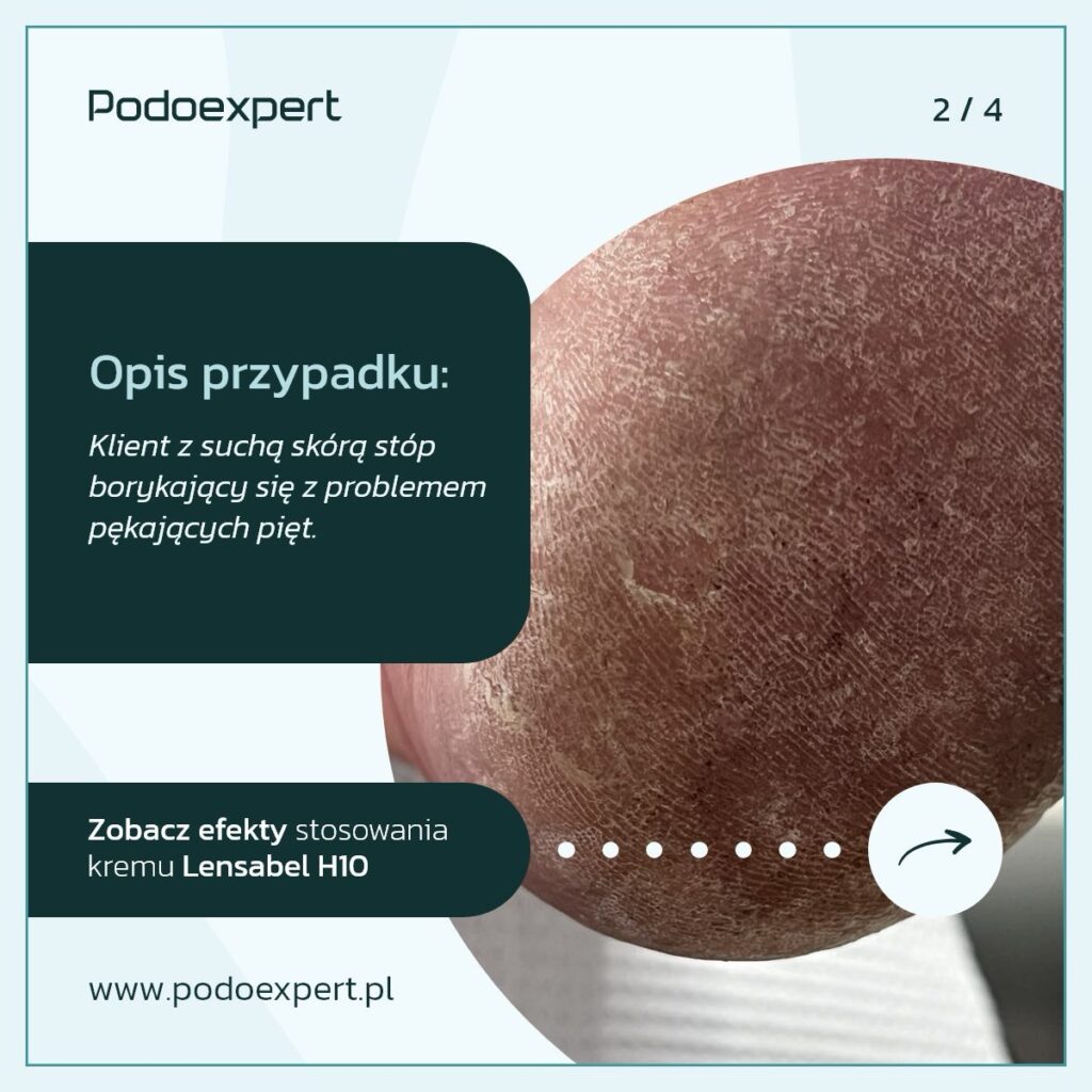 Mocznik krem do stóp 10% Lensa