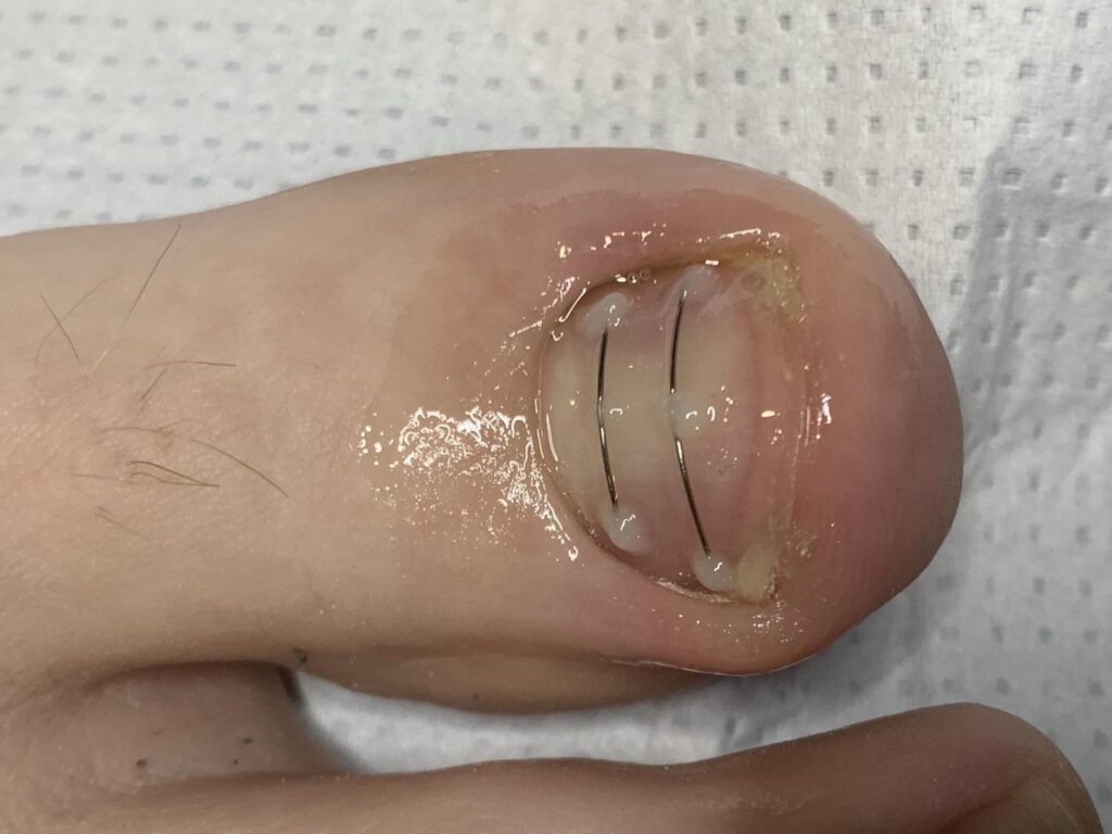 Aplikacja klamry tytanowej na paznokciu. Korekcja wrastających paznokci